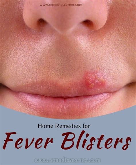 Home Remedies for Fever Blisters | Remedies Corner | Home remedies for fever, Home remedies ...