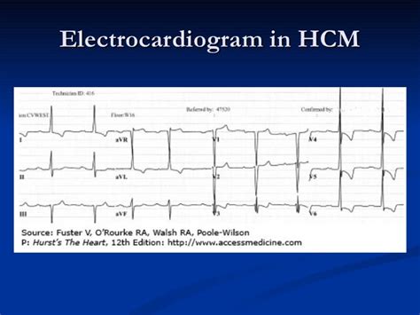 HYPERTROPHIC OBSTRUCTIVE CARDIOMYOPATHY (HOCM)