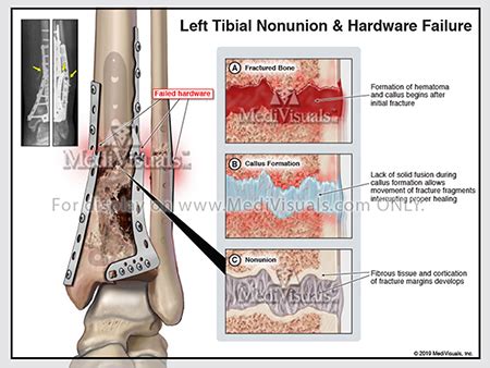 Bone Remodeling: Fracture Healing Process and Associated Complications - Medivisuals Inc.