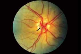 Intraocular Optic Nerve Tumors - Visual Acuity - ALPF Medical Research