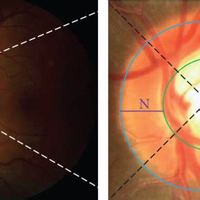 The structures of the optic nerve head. (a) Normal, (b) glaucoma. | Download Scientific Diagram