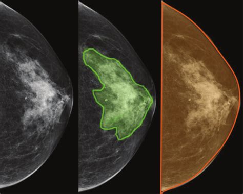 Mammogram Density