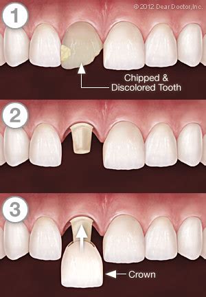 Crowns and Bridges | Antioch, Richmond, IL | Miles Family Dental