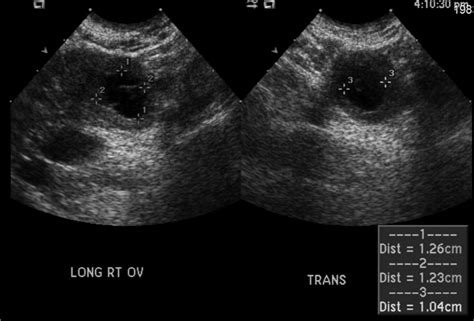 Ruptured Ectopic Pregnancy Ultrasound