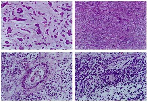 Unusual histologic features of atypical teratoid/rhabdoid tumor. (A)... | Download Scientific ...