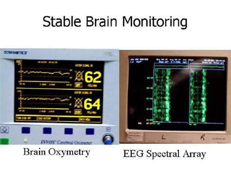 Stable brain oximetry as observed during the surgical procedure ...