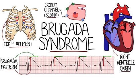 Brugada syndrome: causes, symptoms, risks, treatment | Anxiety Fighters Guide