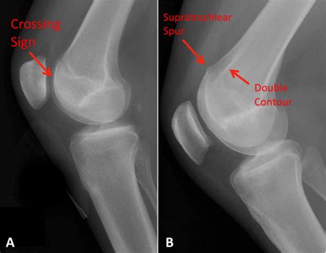 Trochlear Dysplasia | Knee Pain | Colorado Knee Specialist