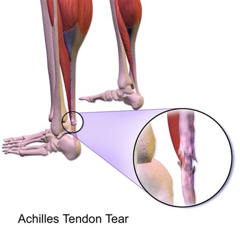 Achilles Tendon Tear