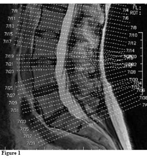 MRI Spine Protocols