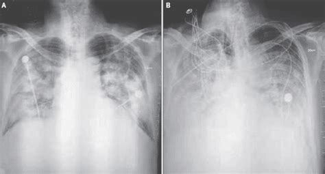 Covid Pneumonia / Cureus Predicting Covid 19 Pneumonia Severity On ...