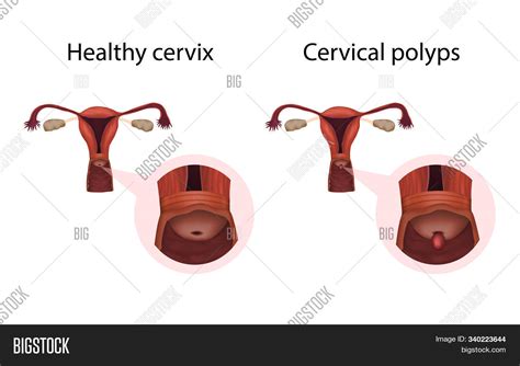 Cervix Polyps Healthy Image & Photo (Free Trial) | Bigstock