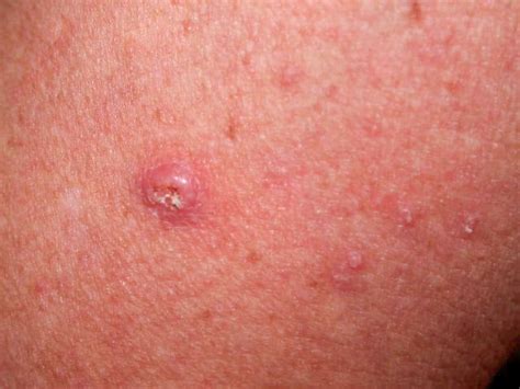 Skin Cancer Pictures | Most Common Skin Cancer Types with Images