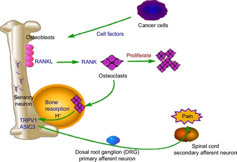 Does Bone Cancer Pain Go Away - CancerWalls