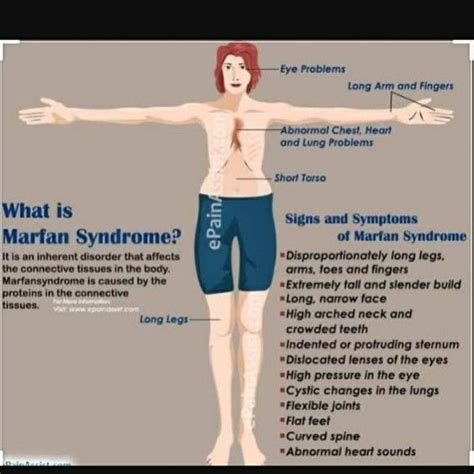 Marphan Syndrome | Marfan syndrome, Eyes problems, Body tissues