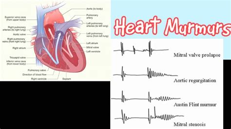 Heart murmur