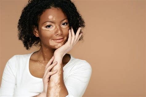 Skin Discoloration: Types, Causes, Treatment, and Prevention | by ...