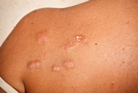 Treating keloid scarring - Dr MediSpa Award Winning Clinics