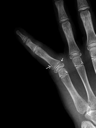 Salter Harris Type 2 Fracture Finger