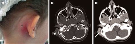 Conservative Management of Acute Mastoiditis in Children ...