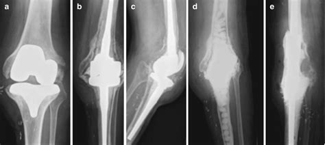 Total Knee Arthroplasty: Complications and Results | Musculoskeletal Key