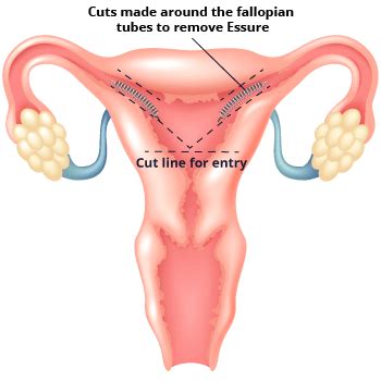 Essure Birth Control - Complications & FDA Black Box Warning