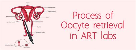 Process of Oocyte retrieval in ART labs