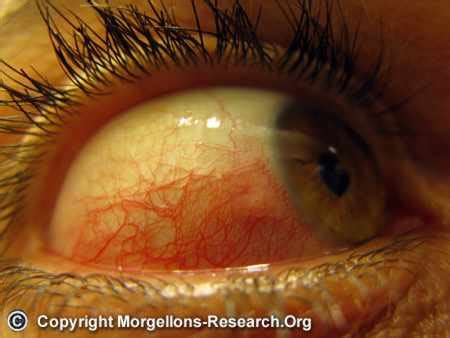 Morgellons symptoms of biofilm infection