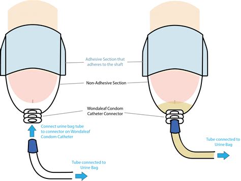 Wondaleaf Adhesive Condom Catheter – Wondaleaf