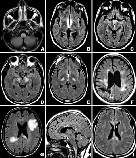 Brain lesions causes, brain lesions diagnosis and brain lesions treatment