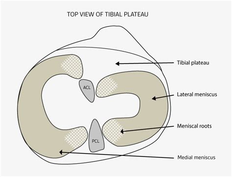 Meniscus root tears - a devastating injury - Dr. Bu Balalla