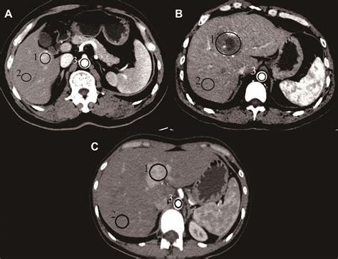 Cavernous Hemangioma Liver