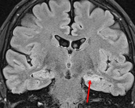 Mesial temporal sclerosis – Radiology Cases