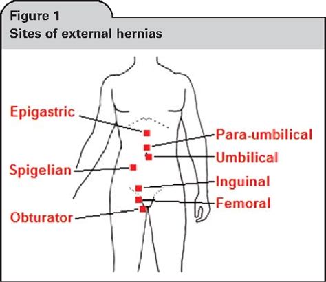 Figure 1 from Frequency of abdominal wall hernias: is classical teaching out of date? | Semantic ...