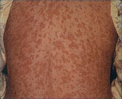 Pin on Skin disorders