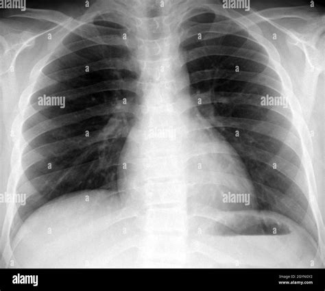 Healthy lungs, X-ray Stock Photo - Alamy