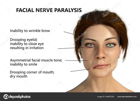 Facial Nerve Paralysis Bell's Palsy Illustration Showing Female One ...