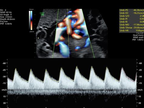 Umbilical Artery Doppler – Sonographic Tendencies