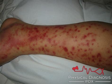 Behcet Disease - Physical Diagnosis PDX