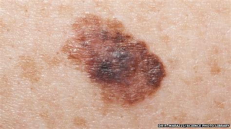 Hospitals see rapid rise in skin cancer - BBC News