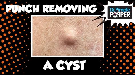 A Punch Removal of a Cyst! With Dr Pimple Popper - YouTube