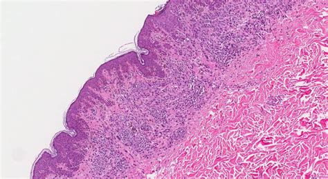 Compound nevus | Ottawa Atlas of Pathology