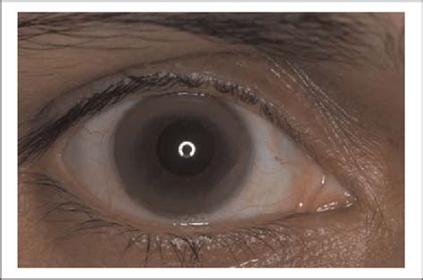 Kayser-Fleischer ring in the right eye of our patient | Download Scientific Diagram