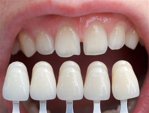 How to look after your composite resin veneers, 4 great tips! - Dentist Mandurah | Platinum ...