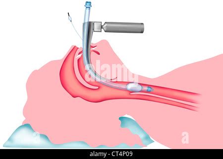 TRACHEAL INTUBATION Stock Photo - Alamy