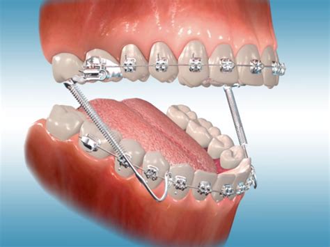 Orthodontic Appliances & Braces | New Smile Orthodontics