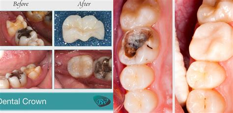 Root Canal Crown Before And After