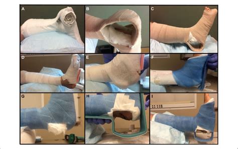 Technique for applying the modified short-leg splint/cast with ...