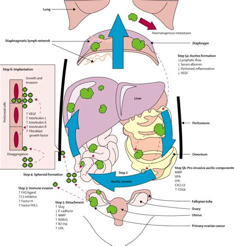 Mechanisms of transcoelomic metastasis in ovarian cancer - The Lancet ...