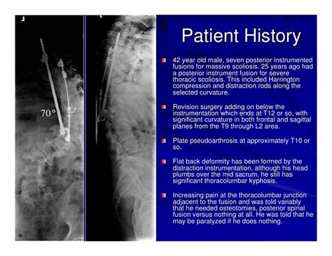 Case Review #1: 42 year old make with Adult Scoliosis Harrington Rod ...